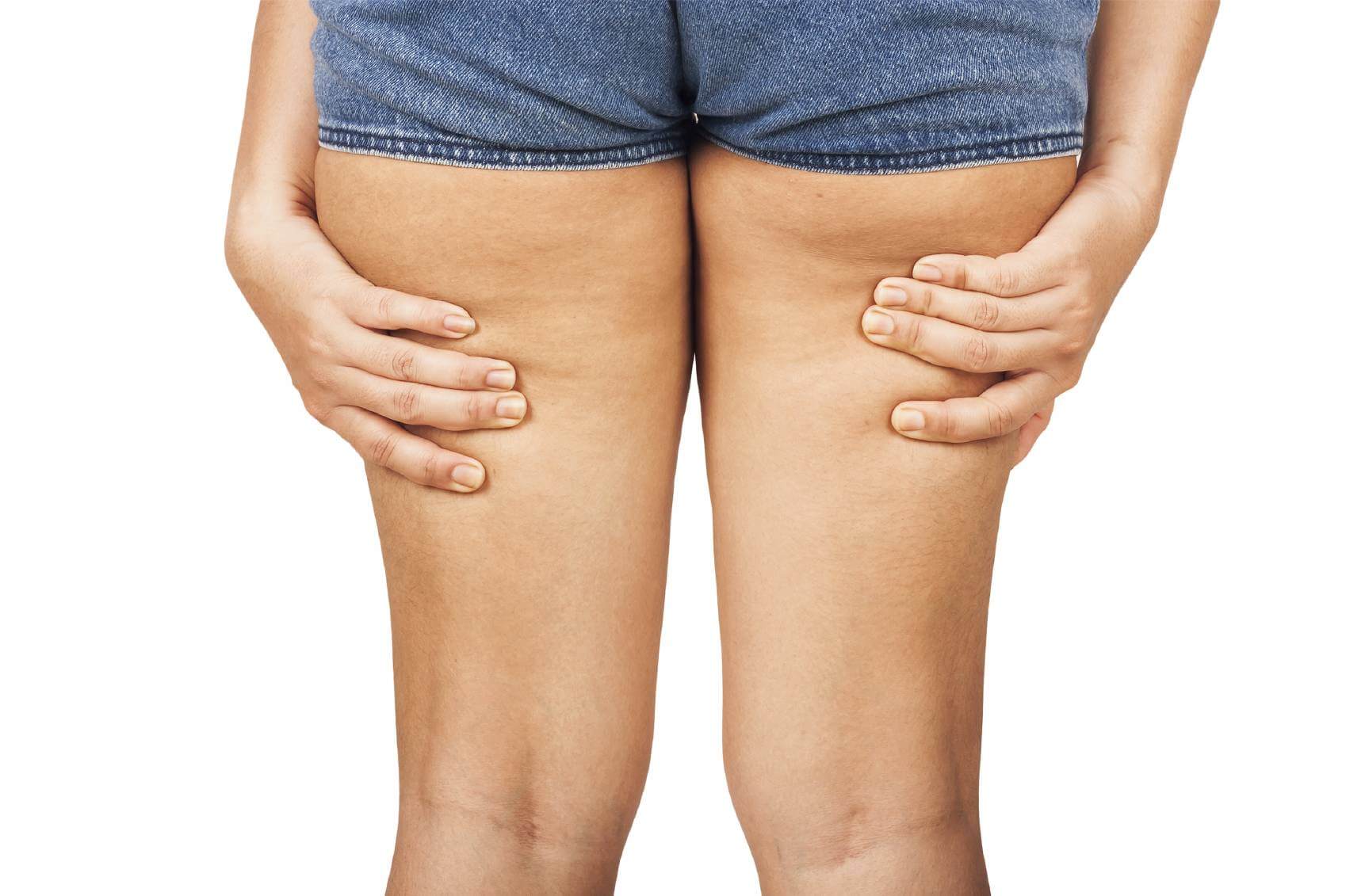Is It Possible To Get Rid Of Cellulite Naturally